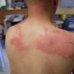 Burns on back of child