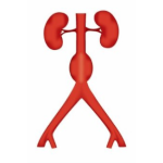 Schematic representation of an Abdominal Aortic Aneurysm